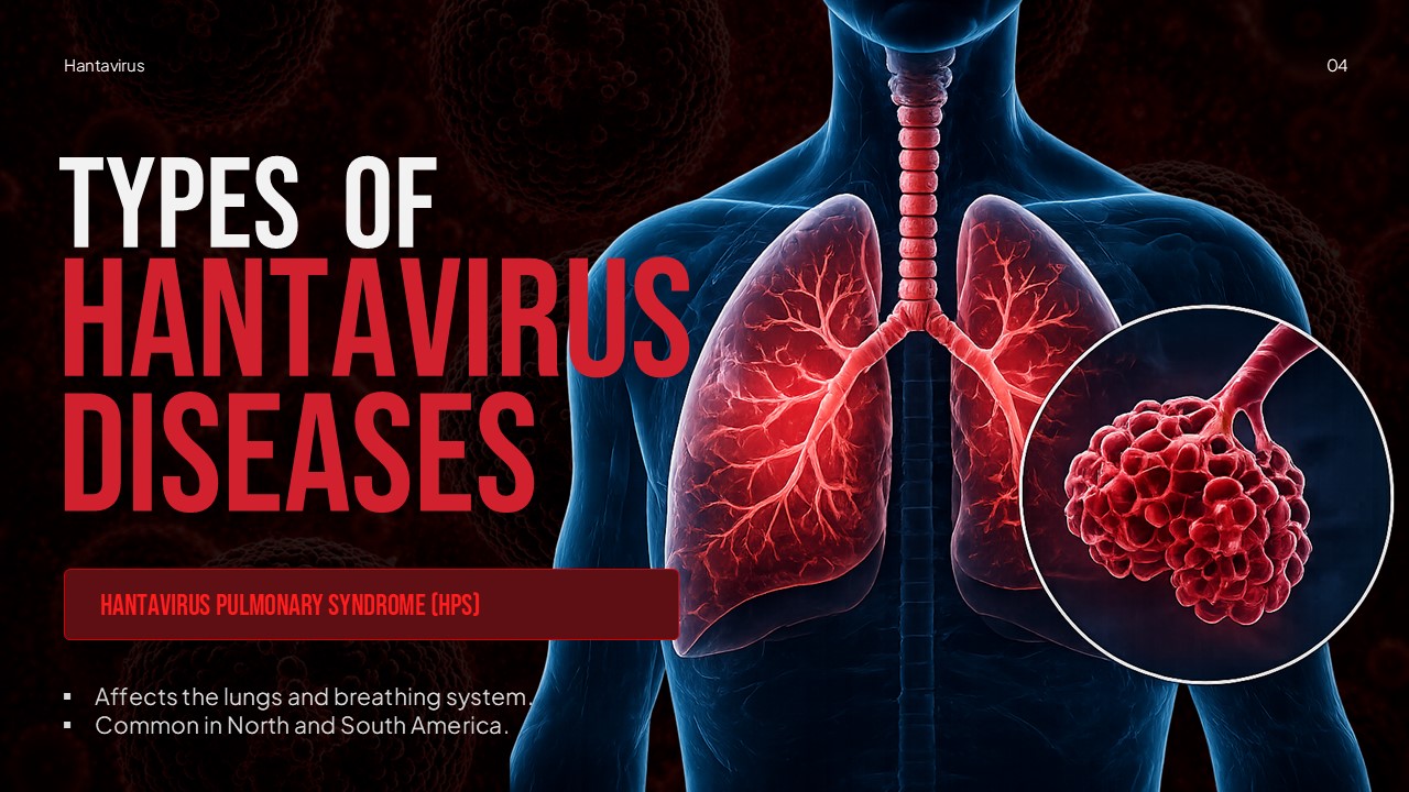 Hantavirus Pulmonary Syndrome slide with lung anatomy illustration